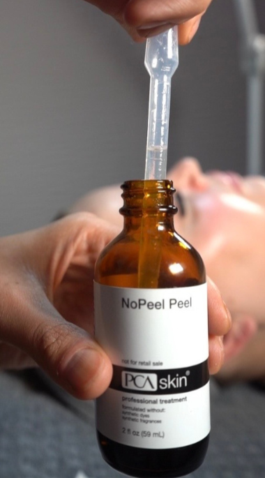 Chemical peel oxford, help pigmentation and sun damage