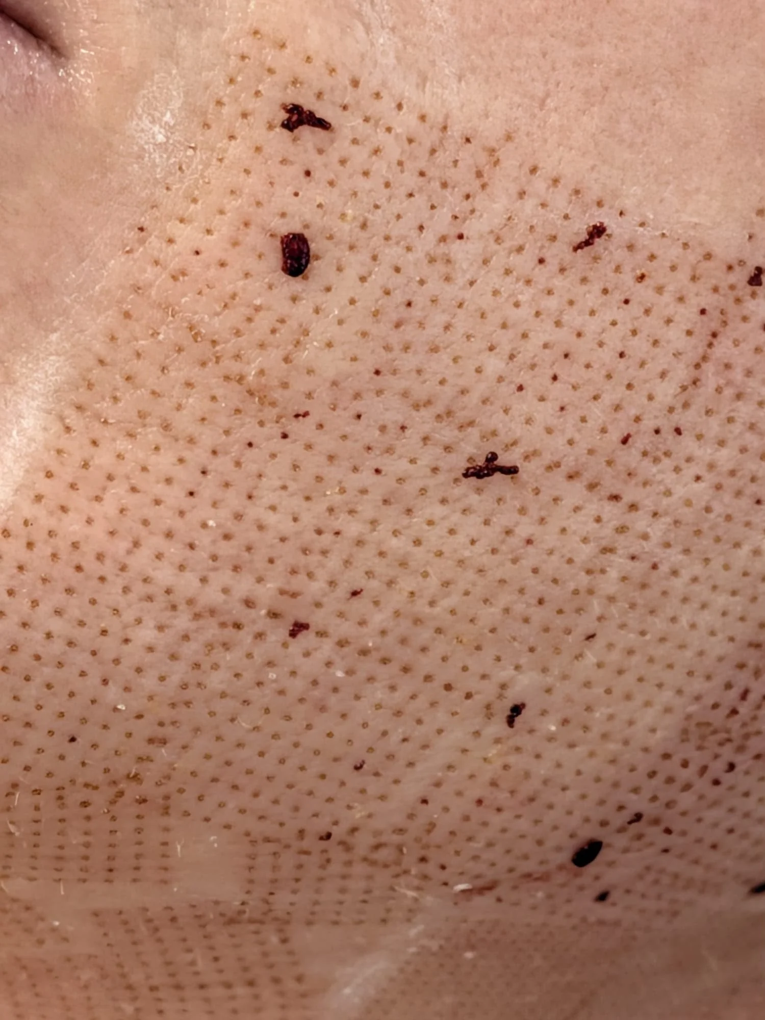Clsoe up of ablative laser coring collums created in the skin with some areas of dried blood and a grid-like pattern across the skin