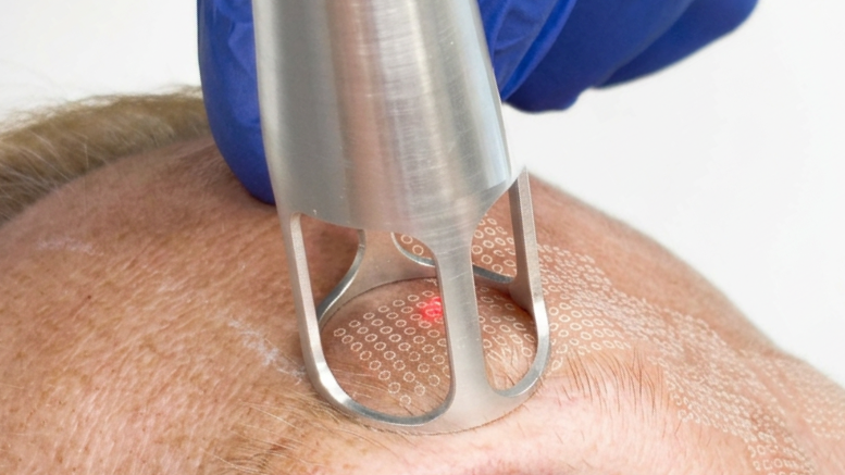 A Safer Alternative to CO2 Laser Resurfacing In Oxford: Say Hello To UltraClear™ .
