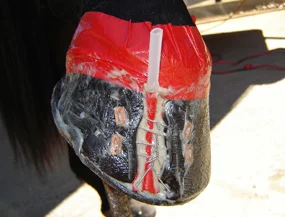  Medicine feeding tube in placed