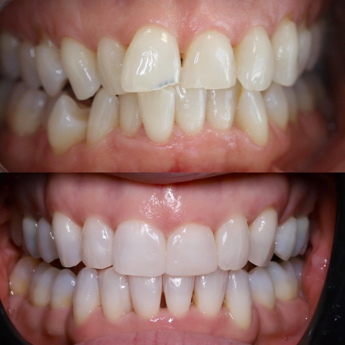 Minimally Invasive Aesthetic Dentistry⛄️

A beautiful result for a lovely patient!😁

Fixed Braces with our Consultant Orthodontist Jo, then I take all the glory with whitening and composite bonding to improve the shade and shape! 🎨 

Our patient wa