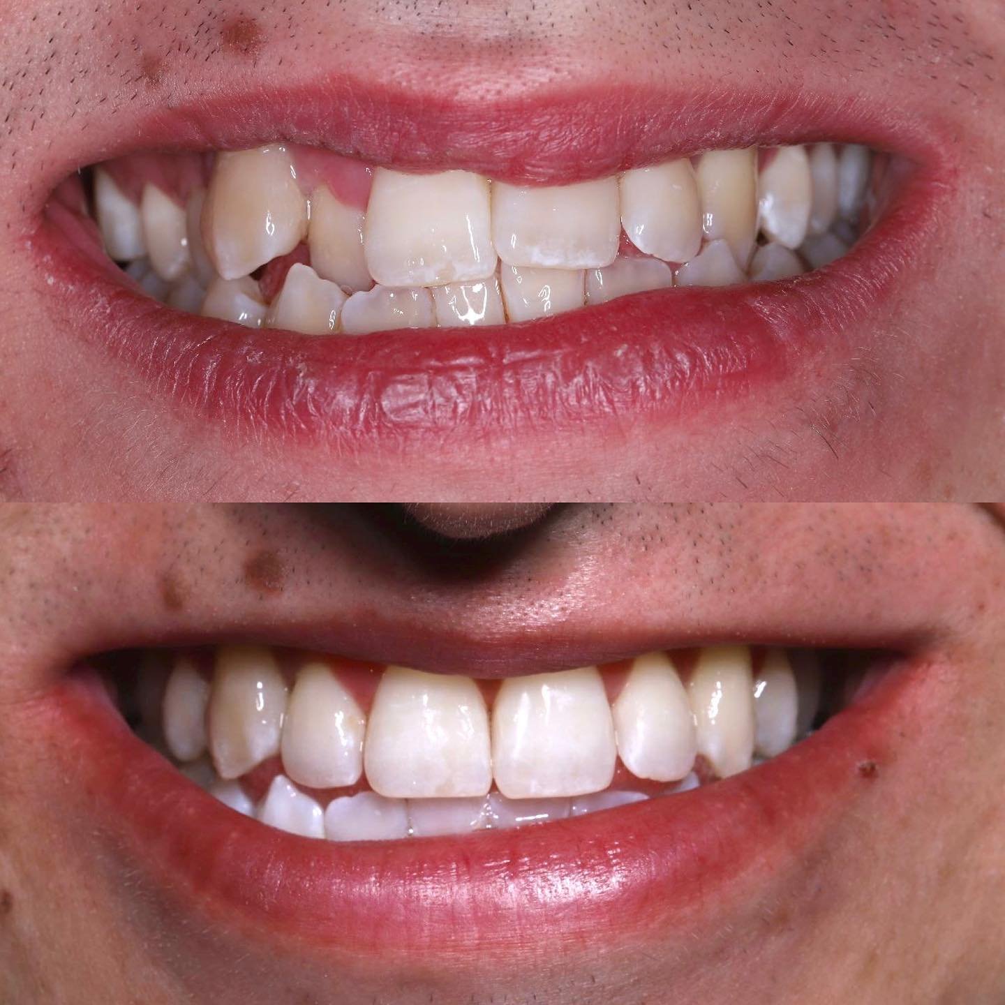 😄Smile!😄

Not too much needs to be said for this one! A really lovely result for an absolute gent - invisalign to get the teeth in the right place and then some professional whitening to brighten everything up! 🦷 

We were after a natural result, 