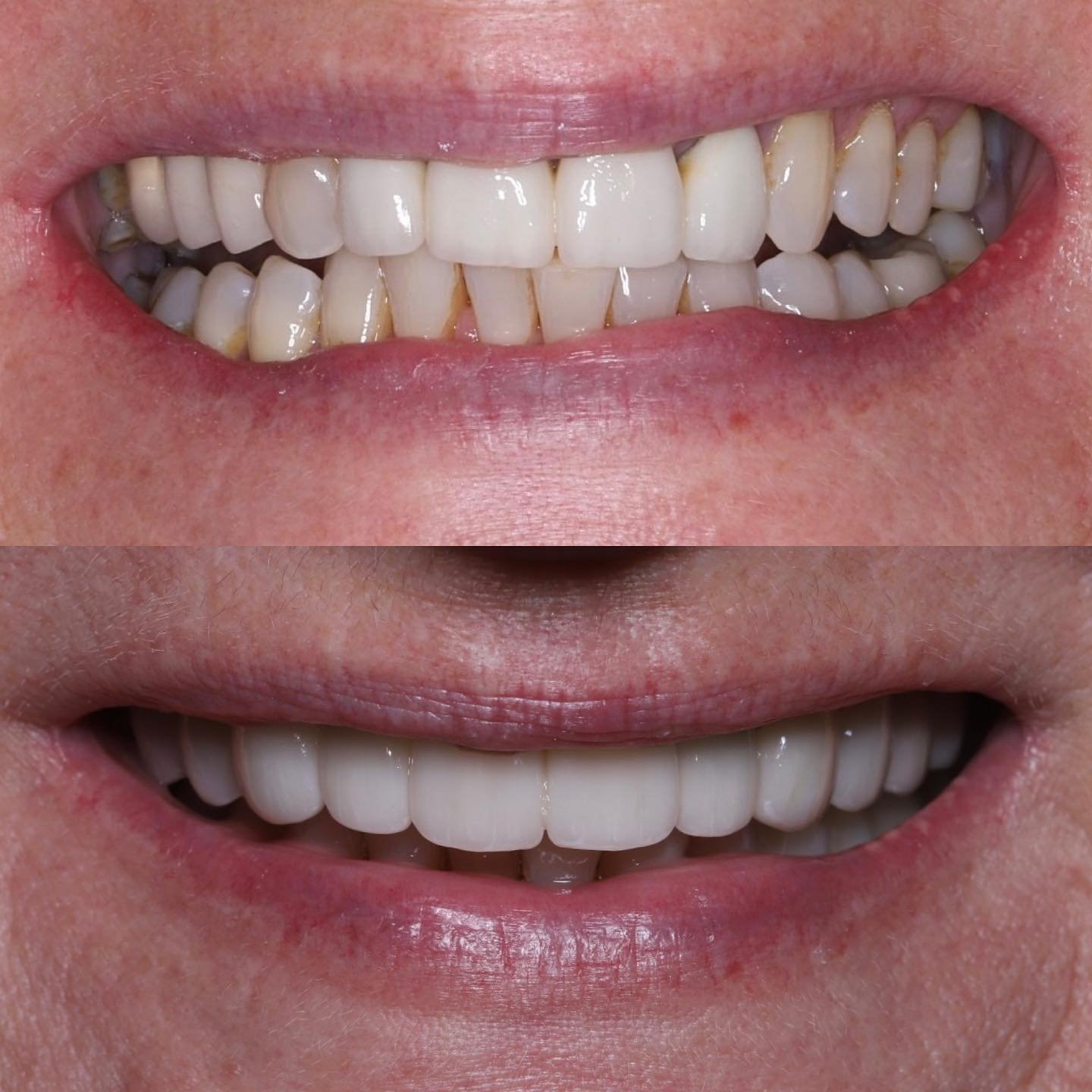🏗️Full Mouth Rehab🏗️

A big case 2 years in the making. This lovely lady came to see me two years ago looking to improve her smile. Old bulky crowns with little character and the worn misaligned bottom front teeth were the main concerns 🔍 

Compre