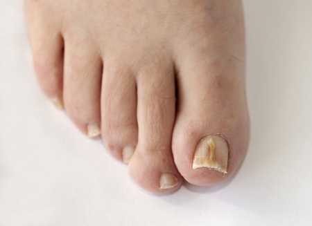 Do's and Don'ts for Fungal Toenail Infections — The Texas Foot Specialists