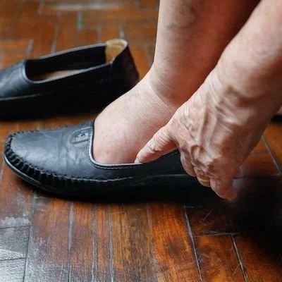 Swollen Ankles 