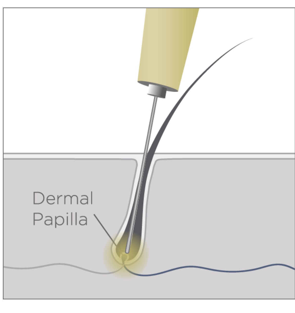diagram of probe in follicle