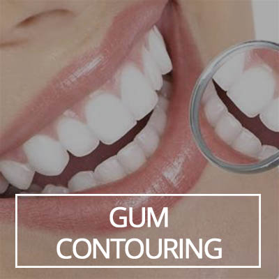 Gum Contouring