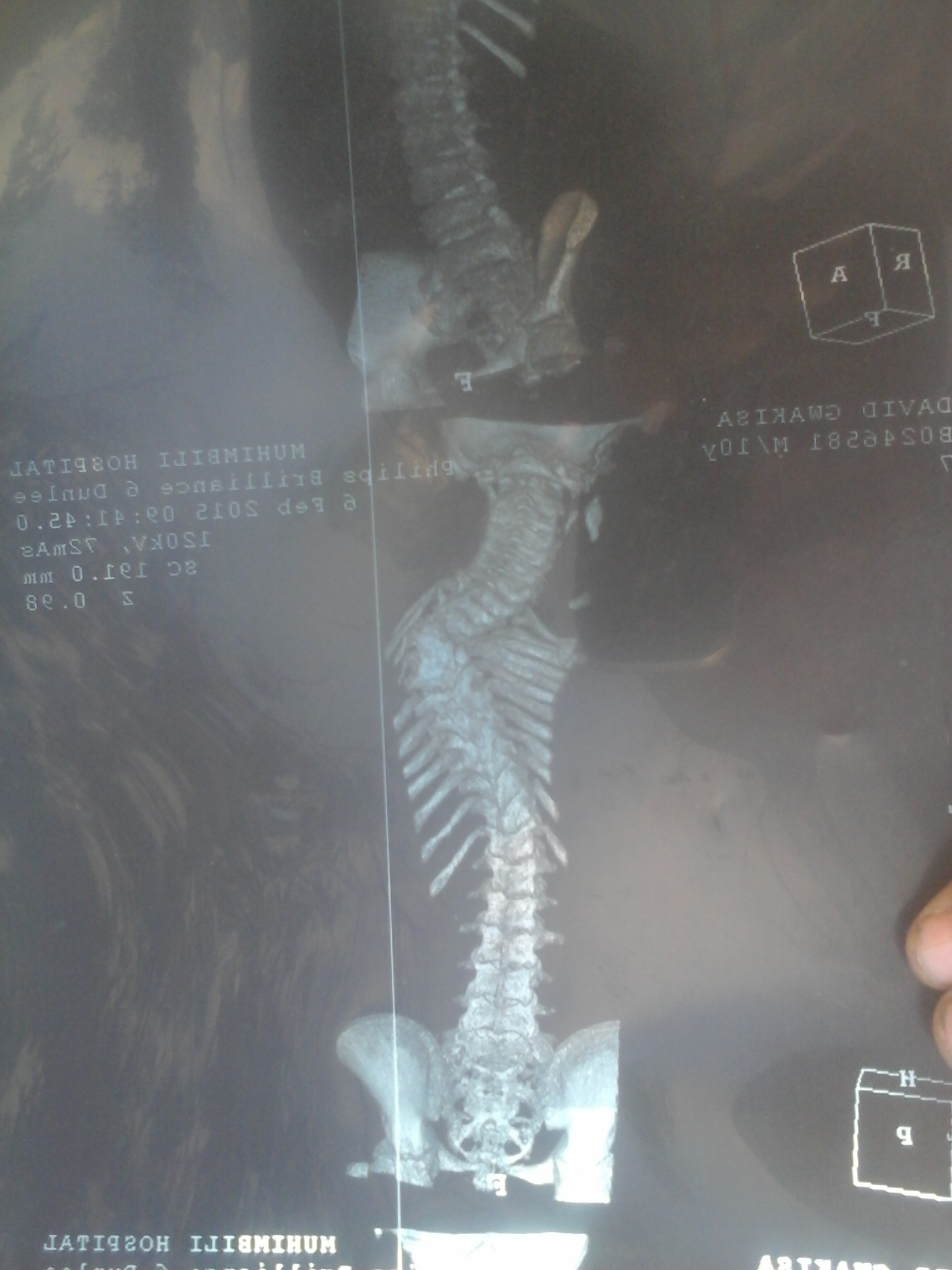 Xray Posterior.jpg