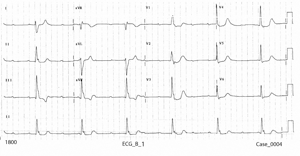 Figure 2. ECG_B_1 taken on arrival at 1800