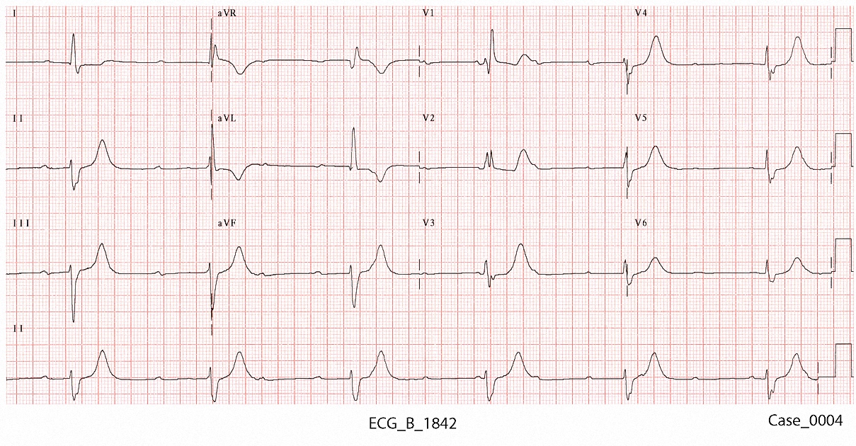 Figure 3. ECG_B_2 taken on arrival at 1842