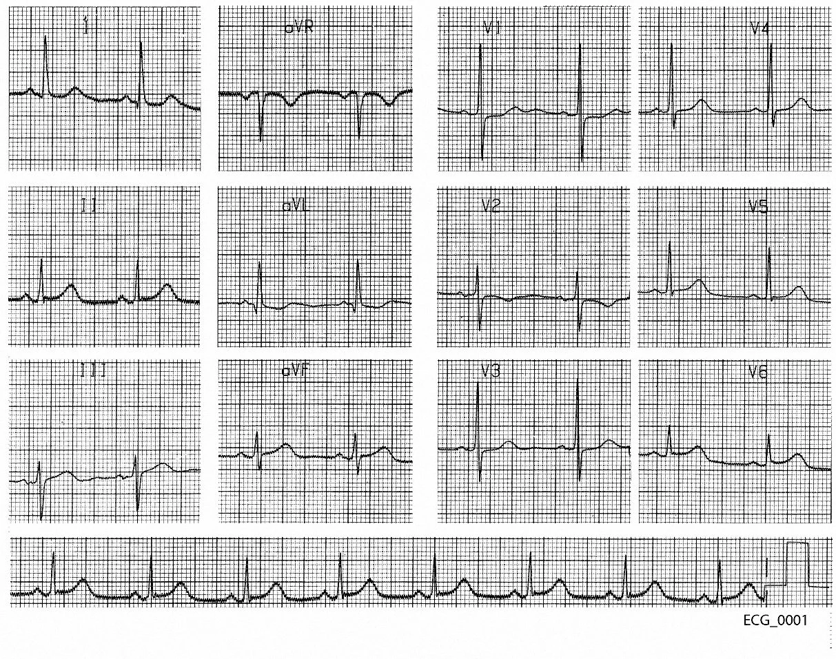 Figure 1. Forty five year old man with atypical chest pain
