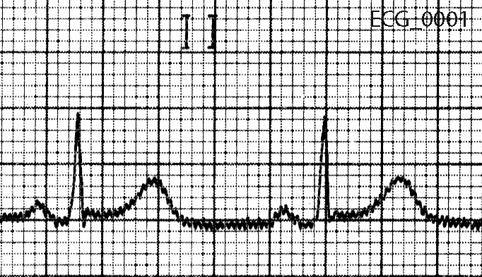 Figure 2. Lead II from forty five year old man with atypical chest pain 