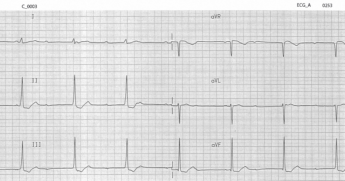 Figure 1. Initial ECG on arrival after an overdose of verapamil