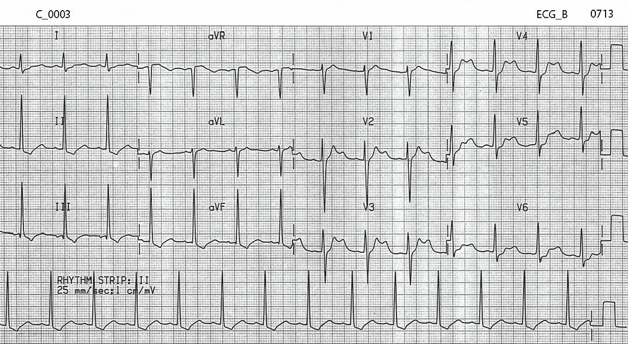 Figure 3. ECG of C_0003 after 5 hours of treatment in the Emergency Department.