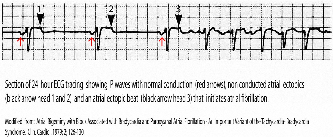 Example of non conducted atrial bigeminal ectopic beats that produce a slow ventricular rate and initiate atrial fibrillation