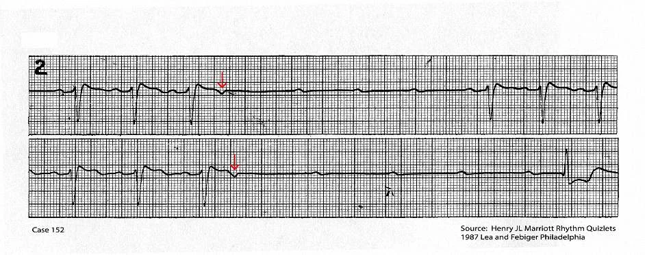 Continuous tracing showing two non conducted atrial ectopic beats (red arrow) that are followed by a short period of AV block and ventricular asystole.