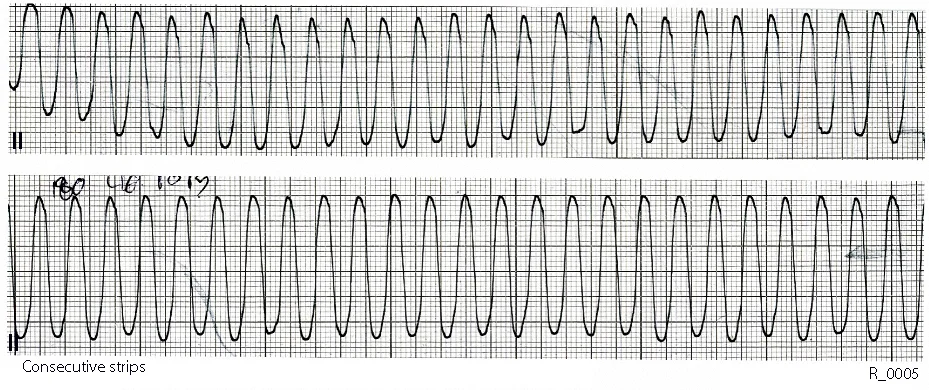 Describe the ECG changes and the rhythm in Case R_0005