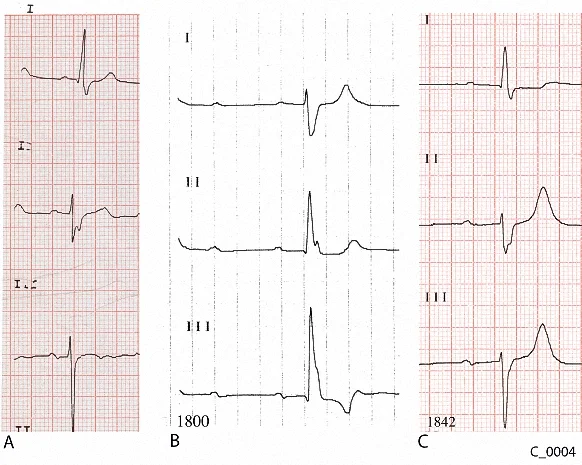 Figure 4. Comparison of leads I to III from the ECGs of Case C_0004. A: ECG taken 6 months before presentation. B: ECG taken at 1800 on presentation. C: ECG taken at 1842 on presentation
