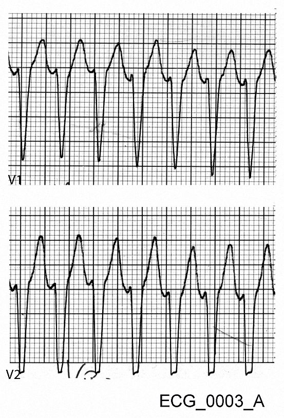 Magnified view of V1 and V2 from ECG_0003_A. The width of the R wave is about 0.04 seconds, and the interval from the start of the R wave and the tip of the S wave is 0.08 seconds.