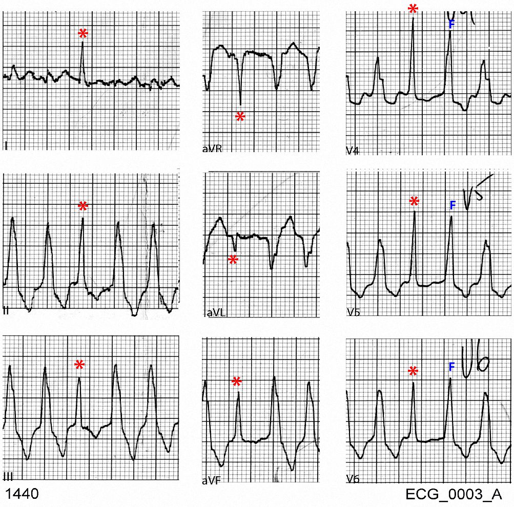 Selected leads from ECG_0003_A showing capture beats (red asterisk) and fusion beats (F)