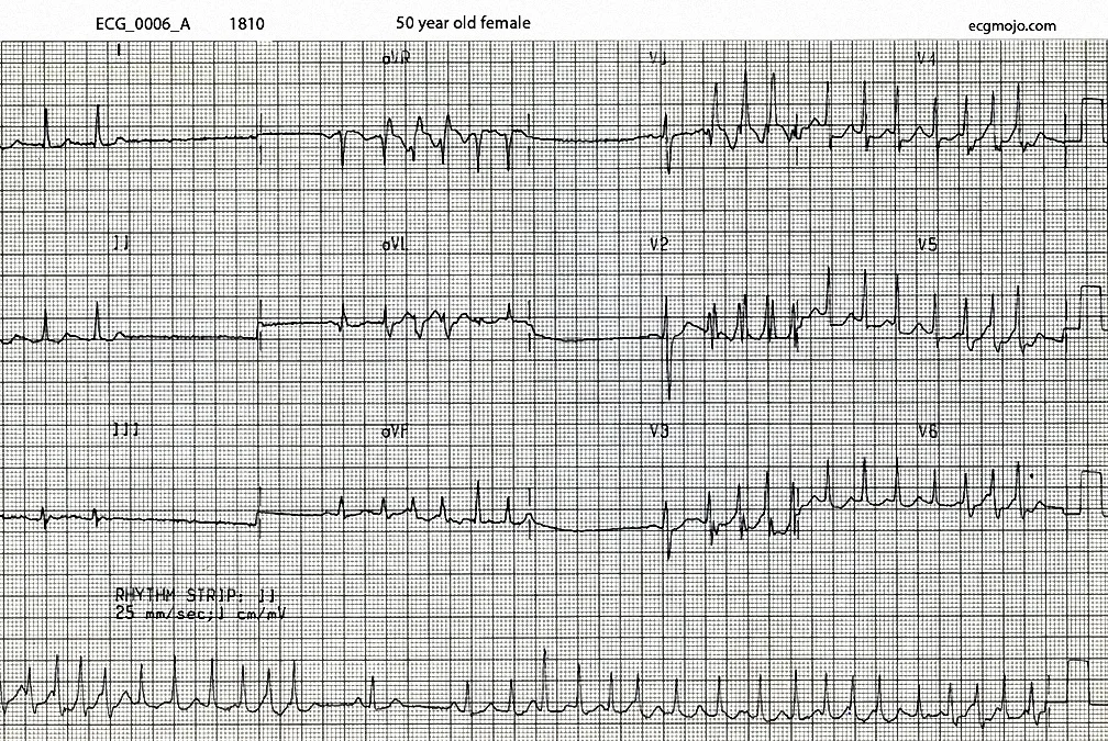 The initial ECG at 1810