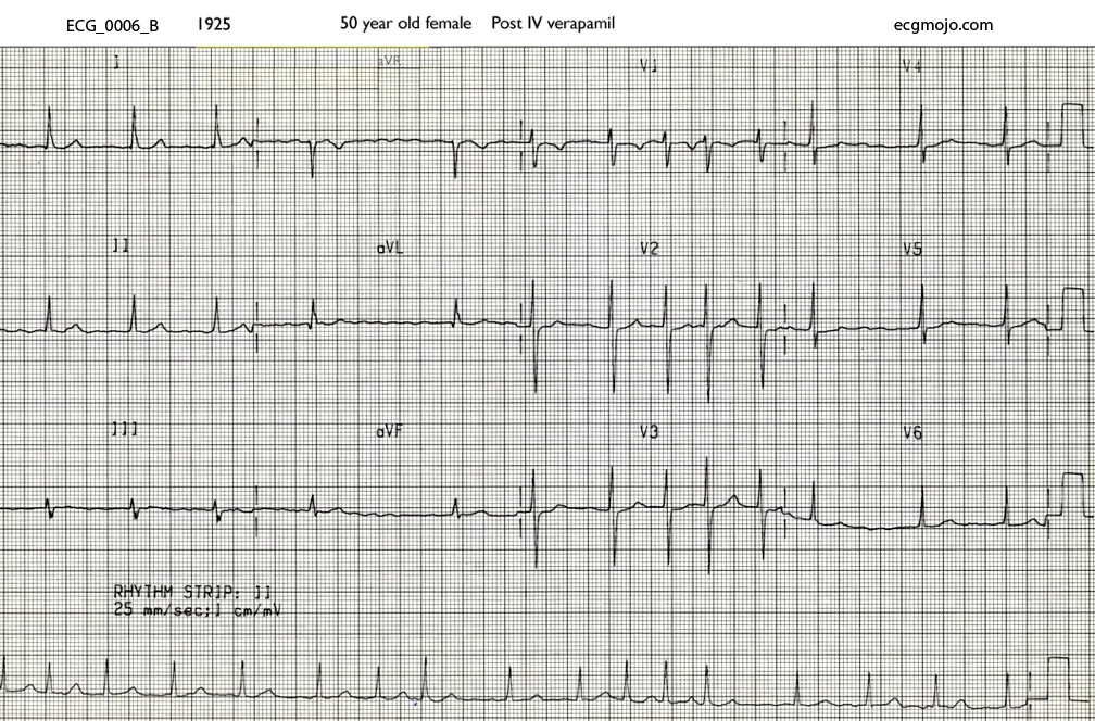 ECG at 1925 after the patient had been treated with intravenous verapamil