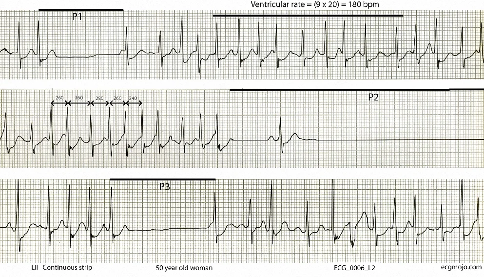 This shows intervals of atrial fibrillation, with a ventricular rate of about 180 beats per minute in the top strip. There are also three pauses (P1 to P3), with a single sinus beat in the second pause (P2). Some of the QRS complexes are preceded by an upward deflection that is suggestive of a delta wave (see the QRS complexes in the middle strip). This upward slope appearance is most marked when the ventricular rate increases to 200 beats per minute or more, as seen in the first half of the middle strip (the R-R intervals of some of the complexes in this strip are also shown). The upward slope is most likely due to aberrant ventricular conduction or merging of the ST-T segments with the QRS complexes. An accessory pathway is unlikely.