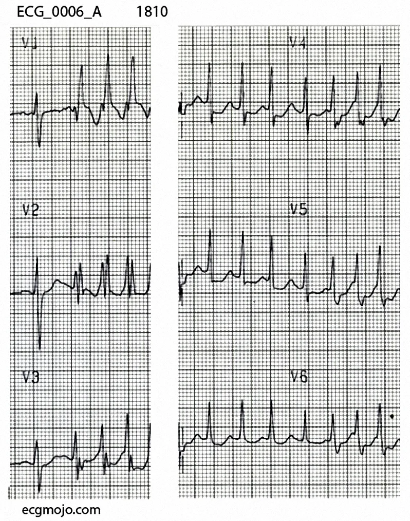 The initial QRS complexin V1 to V3 has normal morphology, but the next three complexes have a right bundle branch block pattern that is consistent with rate related aberrant conduction.