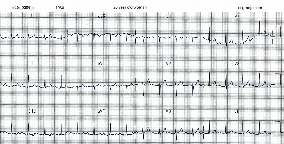 ECG_0009_B taken at 1930 after treatment with verapamil