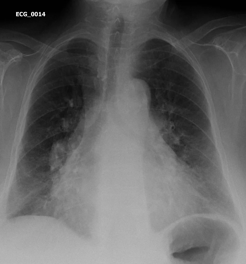 Figure 1. Chest Xray of Case ECG_0014