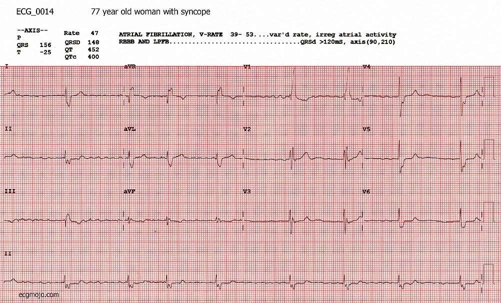 Figure 2. ECG_0014