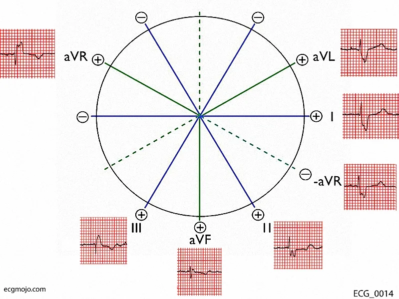 Figure 3. Frontal leads of ECG_0014 in the Cabrera format