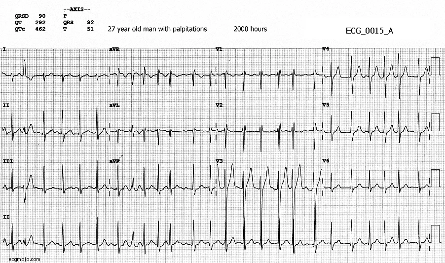 Figure 1. ECG_0015_A