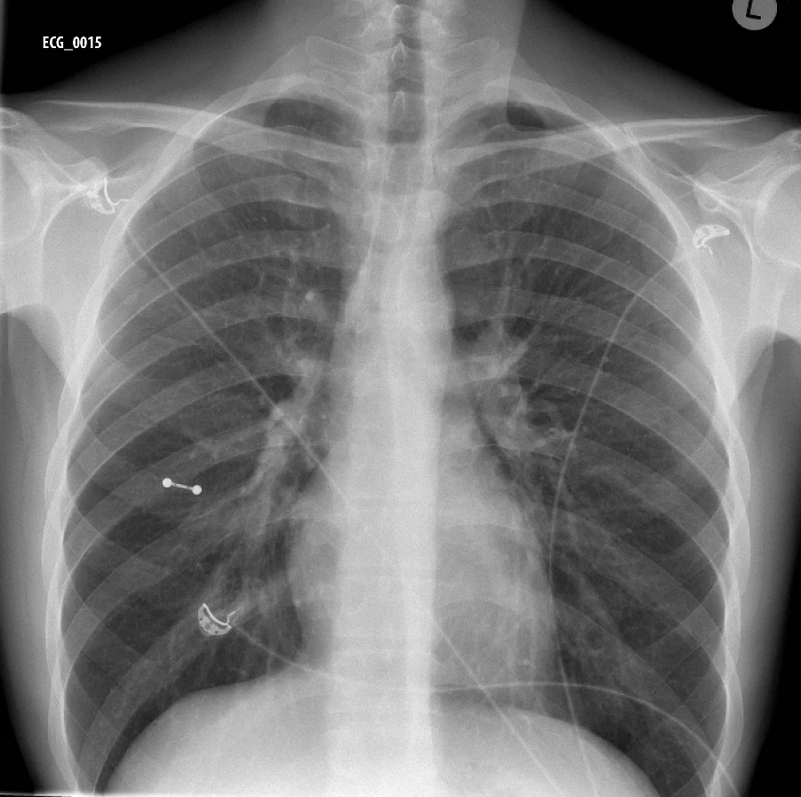 Figure 2. Chest Xray of Case ECG_0015