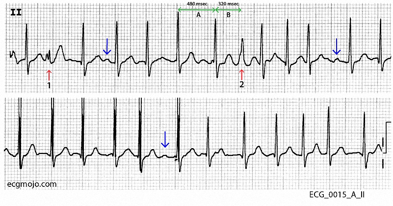 Figure 3. Rhythm stipfrom ECG_0015_A