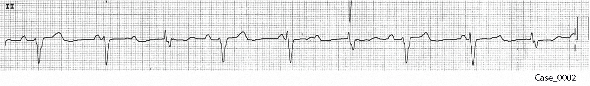 Figure 3. Rhythm strip of C_0002