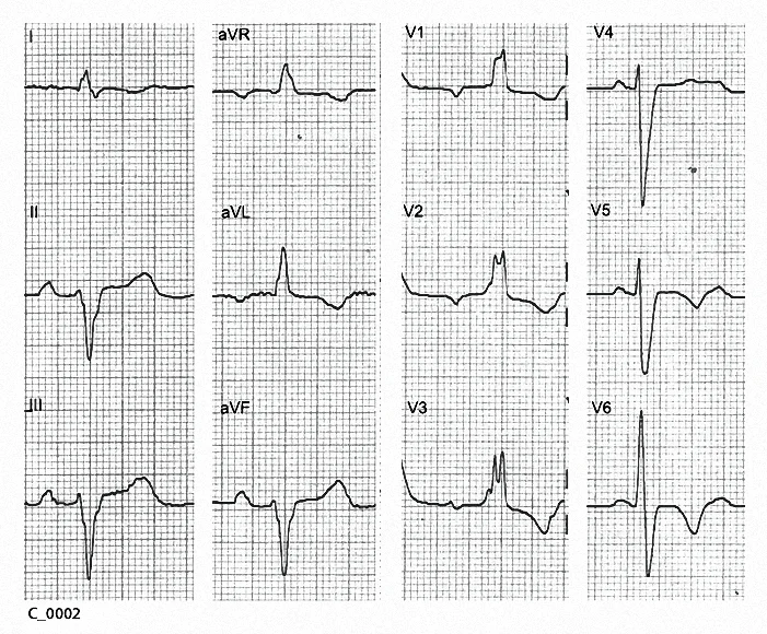 Figure 9. The underlying ventricular rhythm in C_0002. 