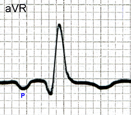 the p wave platos nous p wave ecg