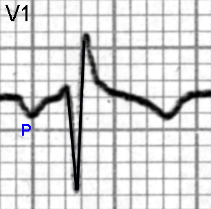 the p wave platos nous p wave ecg