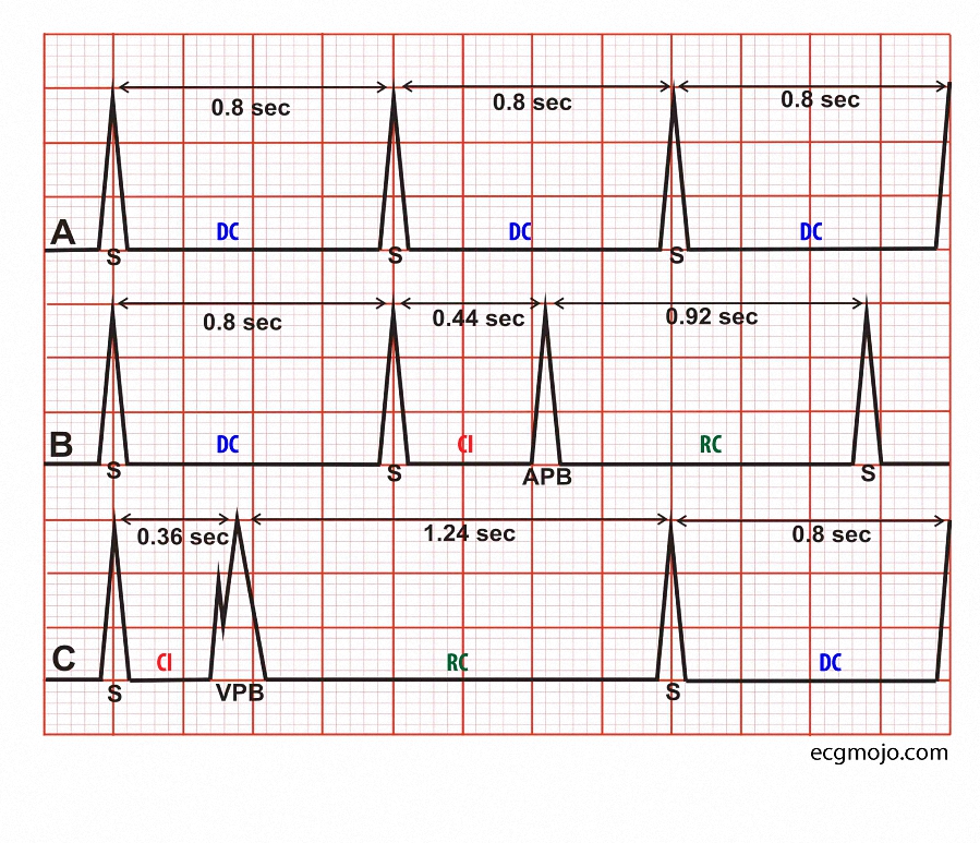 Figure_2. Ectopic beats and their effects on the cardiac cycle. Abbreviations: APB: Atrial premature beat; VPB: Ventricular premature beat; DC: Dominant cycle; CI: Coupling interval; RC: Return cycle