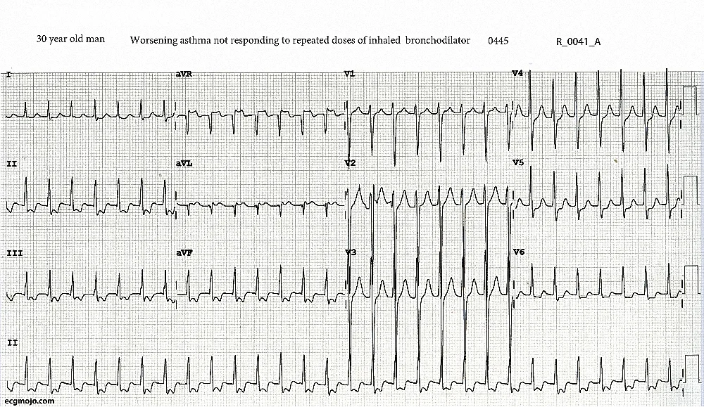 ECG 1 0445