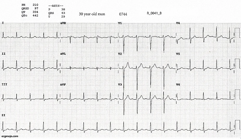 ECG 2 0744