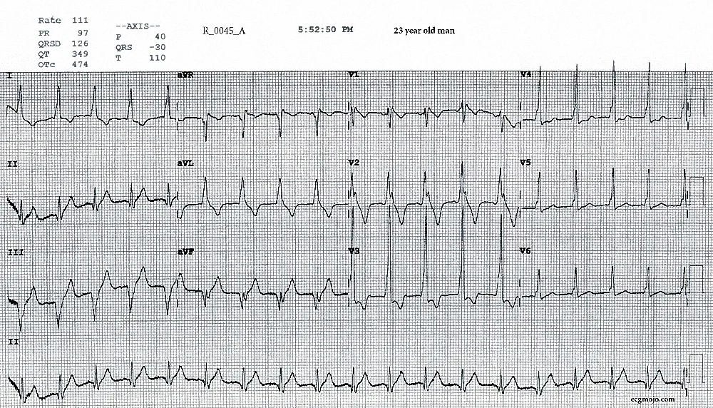 Figure 2. ECG taken at 1752