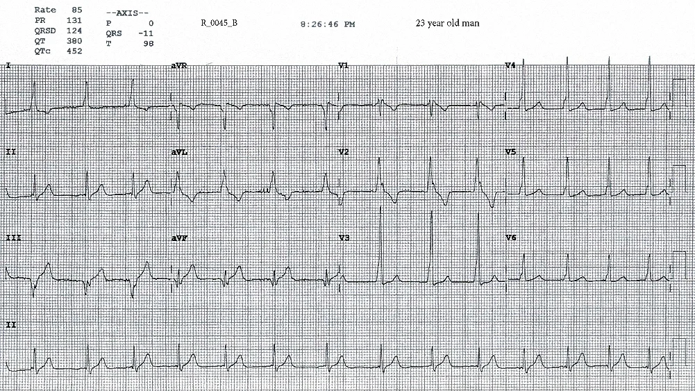 Figure 3. ECG taken at 2026. The heart rate is 85 beats per minute, the ECG features of VPE persist (although the QRS complexes in the inferior leads are narrower), and sinus arrhythmia is seen in the rhythm strip.