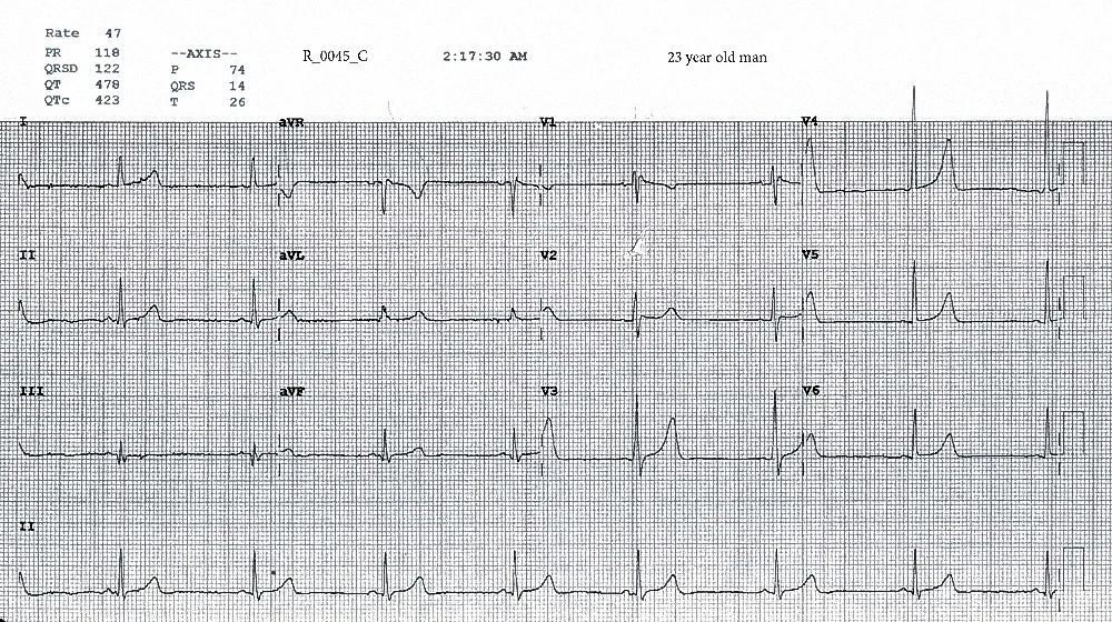 Figure 4. ECG taken at 0217