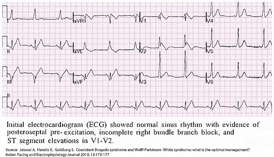 Figure 7. An ECG from a patient with the Brugada syndrome and PES