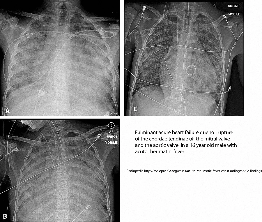 Figure 10. Acute rheumatic fever with acute aortic incompetence and acute mitral incompetence due to rupture of the chordae tendineae. A: Chest Xray shows cardiomegaly and extensive alveolar infiltrates; B: Chest Xray after intubation. An ECHO study showed aortic valve incompetence and mitral vale incompetence; C: Chest Xray after replacement of the aortic valve and the mitral valve.