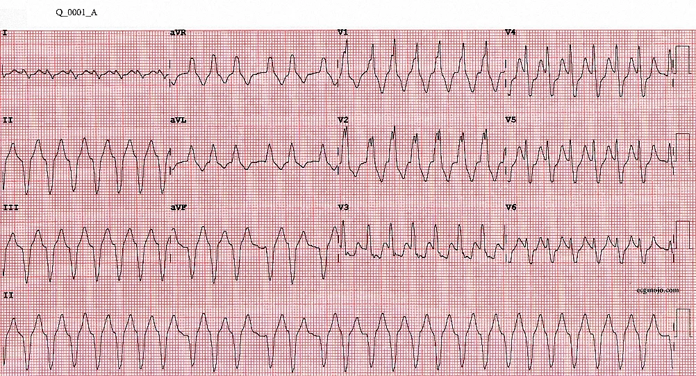Question 1A: Palpitations and dyspnoea in a 84 year old woman