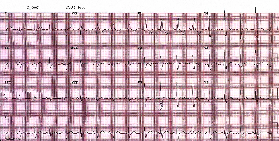 Figure 5. ECG taken at 1614 shows sinus tachycardia (heart rate of about 101 beats per minute), right bundle branch block , electrical alternans - best seen in Leads I to III (the amplitude of the complexes varies from beat to beat), and slight ST elevation and T wave inversion in Leads V2 - V3.