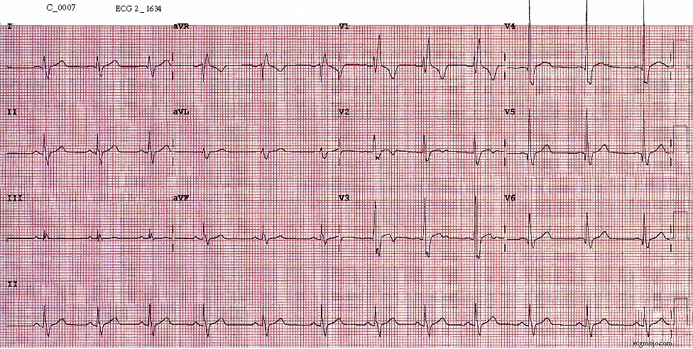 Figure 6. ECG taken at 1634 shows sinus rhythm with a heart rate of about 74 beats per minute. The right bundle branch block persists, there is slight ST elevation in Leads V2 to V4 and there is T wave inversion in Leads V2 and Lead V3